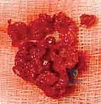 صورة توضيحية لـ عملية تصحيح تشوه الكعبرة البعيدة: استعادة دقيقة لوظيفة الرسغ مع الأستاذ الدكتور محمد هطيف في صنعاء