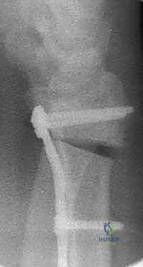 صورة طبية: عملية تصحيح تشوه الكعبرة البعيدة: استعادة دقيقة لوظيفة الرسغ مع الأستاذ الدكتور محمد هطيف في صنعاء