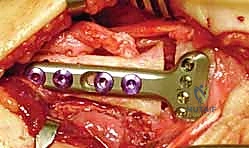 صورة طبية أثناء تثبيت المس
![صورة طبية: عملية تصحيح تشوه الكعبرة البعيدة: استعادة دقيقة لوظيفة الرسغ مع الأستاذ الدكتور محمد هطيف في صنعاء