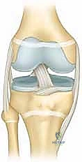 Extended Trochanteric Osteotomy for Complex Total Hip Arthroplasty: An Intraoperative Masterclass