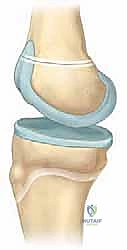 Distal Femoral Physeal Fractures: An Intraoperative Masterclass