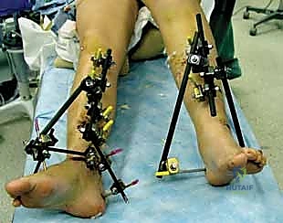 صورة طبية: التثبيت الخارجي لعظم الساق: دليل شامل للمرضى مع الأستاذ الدكتور محمد هطيف