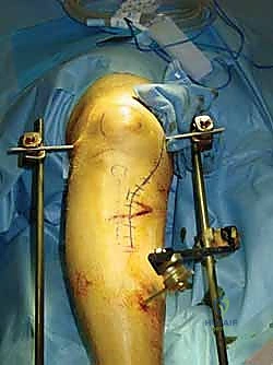 Illustration of pins are placed - Dr. Mohammed Hutaif