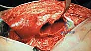 Surgical Dislocation of the Hip for Femoroacetabular Impingement: A Masterclass