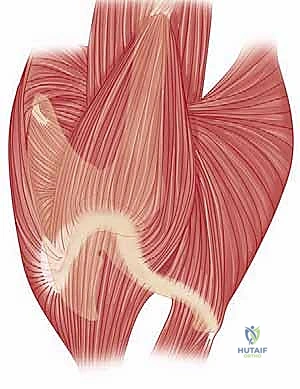 صورة شعاعية توضح التثبيت داخل النخاع