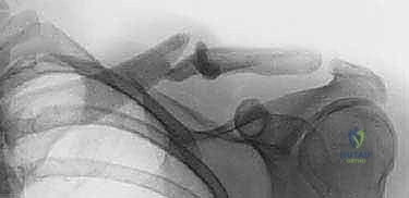 تشريح عظم الترقوة