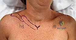 صورة أشعة توضح كسر الترقوة