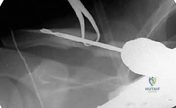 صورة توضيحية لـ تثبيت كسور الترقوة داخل النخاع: دليلك الشامل للتعافي الفعال