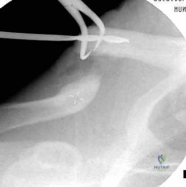 تثبيت كسور الترقوة داخل النخاع: دليلك الشامل للتعافي الفعال