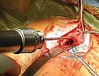 صورة توضيحية لـ تثبيت كسور الترقوة داخل النخاع: دليلك الشامل للتعافي الفعال