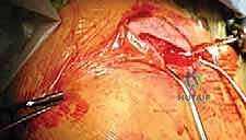 صورة طبية: تثبيت كسور الترقوة داخل النخاع: دليلك الشامل للتعافي الفعال