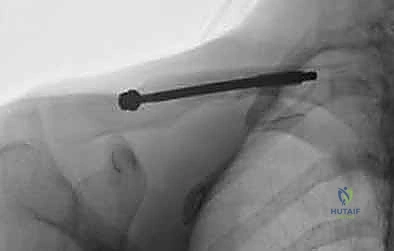 صورة طبية: تثبيت كسور الترقوة داخل النخاع: دليلك الشامل للتعافي الفعال