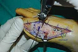 Mastering the Anterior Approach to the Humerus: Surgical Anatomy, Indications, & Techniques
