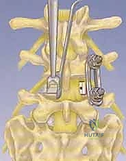 الضغط على جذور الأعصاب الشوكية