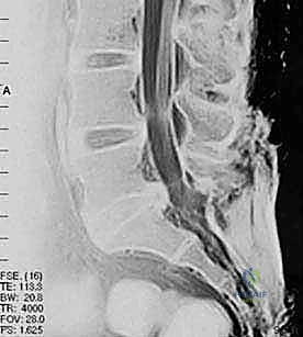 تقنية PLIF الجراحية