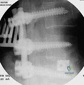 إدخال القفص العظمي في تقنية TLIF