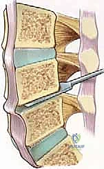 إ
![صورة طبية: دمج الفقرات القطنية: تقنيات PLIF و TLIF المتطورة لإنهاء آلام الظهر