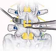 صورة طبية: دمج الفقرات القطنية: تقنيات PLIF و TLIF المتطورة لإنهاء آلام الظهر