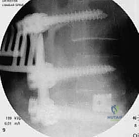 صورة طبية: دمج الفقرات القطنية: تقنيات PLIF و TLIF المتطورة لإنهاء آلام الظهر