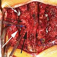 صورة طبية: دمج الفقرات القطنية: تقنيات PLIF و TLIF المتطورة لإنهاء آلام الظهر