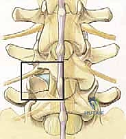 صورة توضيحية لـ دمج الفقرات القطنية: تقنيات PLIF و TLIF المتطورة لإنهاء آلام الظهر