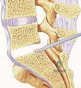 صورة طبية: دمج الفقرات القطنية: تقنيات PLIF و TLIF المتطورة لإنهاء آلام الظهر