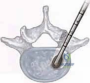 صورة طبية: دمج الفقرات القطنية: تقنيات PLIF و TLIF المتطورة لإنهاء آلام الظهر