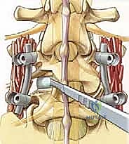 صورة طبية: دمج الفقرات القطنية: تقنيات PLIF و TLIF المتطورة لإنهاء آلام الظهر