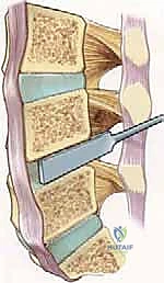 صورة طبية: دمج الفقرات القطنية: تقنيات PLIF و TLIF المتطورة لإنهاء آلام الظهر
