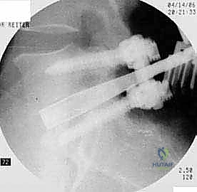 صورة طبية: دمج الفقرات القطنية: تقنيات PLIF و TLIF المتطورة لإنهاء آلام الظهر