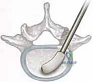 خطوة إزالة الضغط العصبي