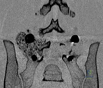 تقنية TLIF الجراحية للوصول الجانبي