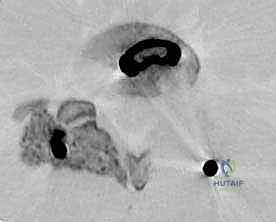صورة طبية: دمج الفقرات القطنية: تقنيات PLIF و TLIF المتطورة لإنهاء آلام الظهر