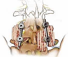 صورة شعاعية توضح الحاجة للتدخل الجراحي