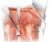 التحضير قبل جراحة استئصال الجسم الفقري الصدري