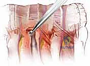خطوات إجراء عملية استئصال الجسم الفقري الصدري الأمامي