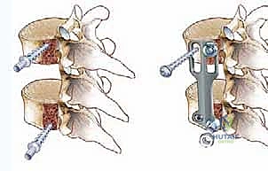 استئصال الجسم الفقري الصدري الأمامي: دليل شامل للمرضى مع الأستاذ الدكتور محمد هطيف
