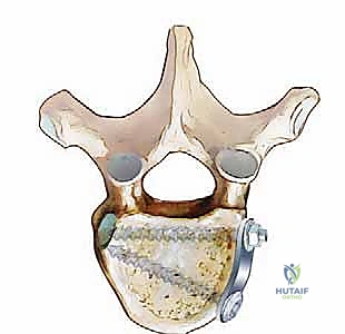 صورة توضيحية لـ استئصال الجسم الفقري الصدري الأمامي: دليل شامل للمرضى مع الأستاذ الدكتور محمد هطيف