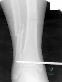 Illustration of tibial shaft fractures - Dr. Mohammed Hutaif