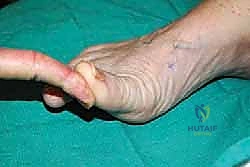 تكوّن مسامير اللحم وألم مشط القدم المنتقل