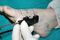 التخطيط الجراحي الدقيق قبل العملية