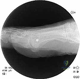 تثبيت العظم باستخدام الشرائح والمسامير التيتانيوم