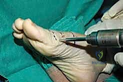 الشق الجراحي الدقيق للوصول للعظم