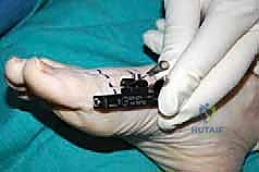 إجراء القص العظمي بدقة بالغة