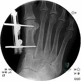 صورة توضيحية لـ إطالة مشط القدم الأول لعلاج إبهام القدم الأروح المرتجع: حل نهائي لآلام القدم المزمنة في صنعاء