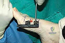 صورة توضيحية لـ إطالة مشط القدم الأول لعلاج إبهام القدم الأروح المرتجع: حل نهائي لآلام القدم المزمنة في صنعاء