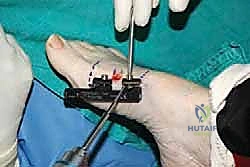 صورة توضيحية لـ إطالة مشط القدم الأول لعلاج إبهام القدم الأروح المرتجع: حل نهائي لآلام القدم المزمنة في صنعاء