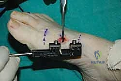 العظام السمسمانية وآلية الرافعة في القدم