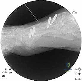 صورة توضح قصر مشط القدم الأول بعد جراحة سابقة