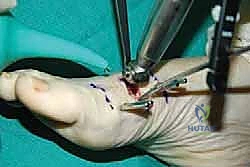 تشريح عظام ومفاصل مقدمة القدم